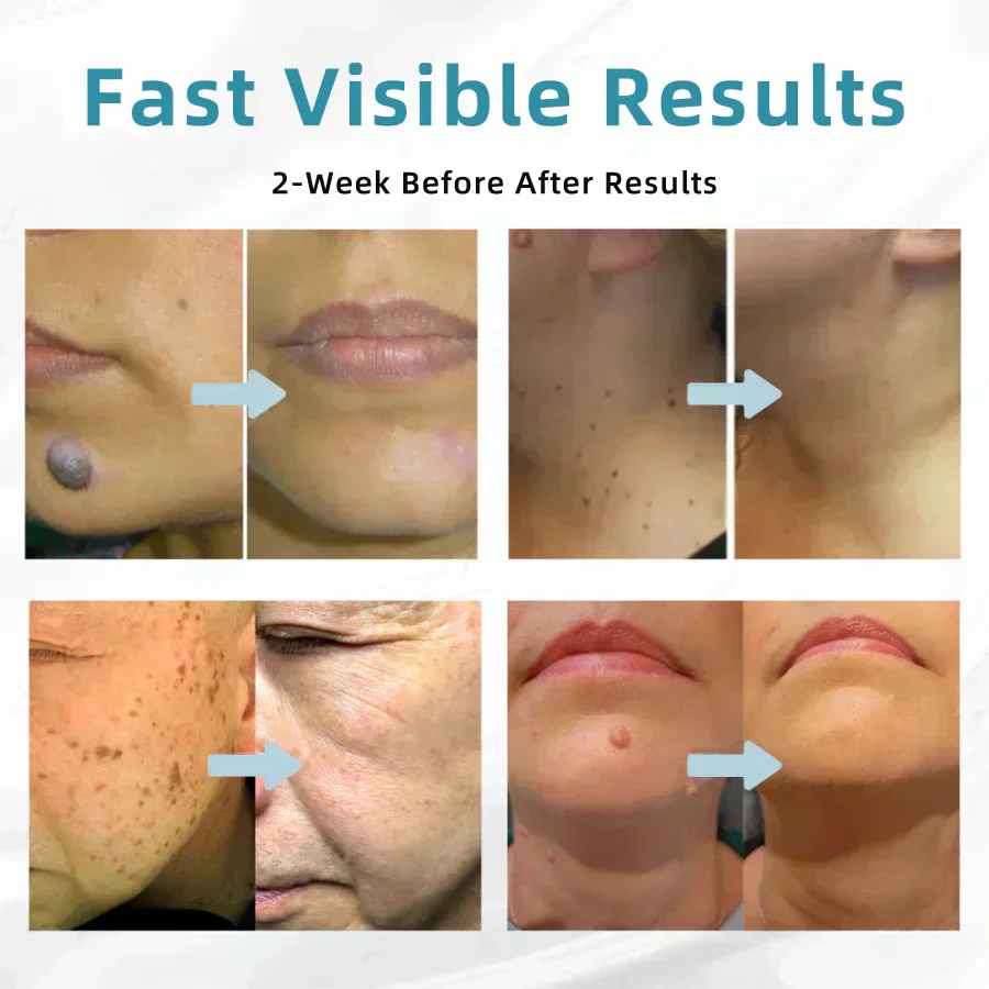 DermaBeam Pro – Erase Skin Flaws Instantly + 50% OFF - Image 12