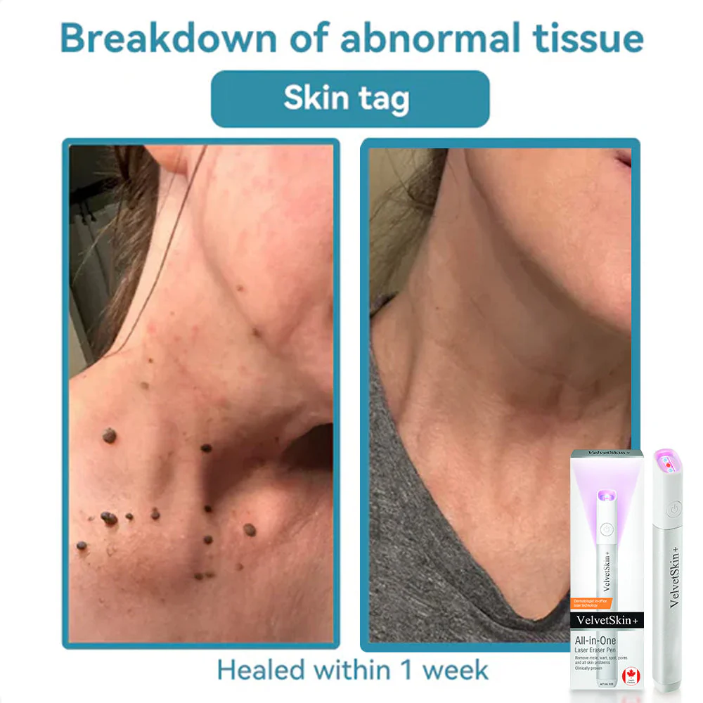 DermaBeam Pro – Erase Skin Flaws Instantly + 50% OFF - Image 15